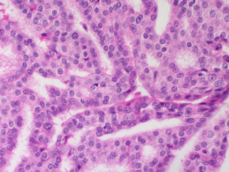 File:Breast PapillaryCarcinoma Invasive HP SNP.jpg