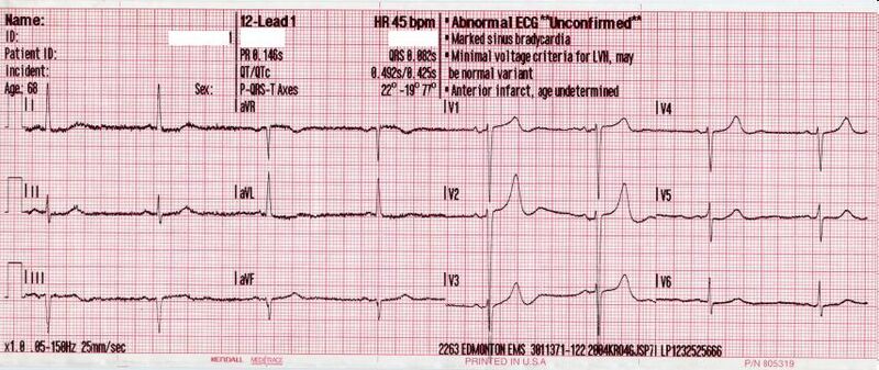 File:12 lead sinus bradycardia.JPG