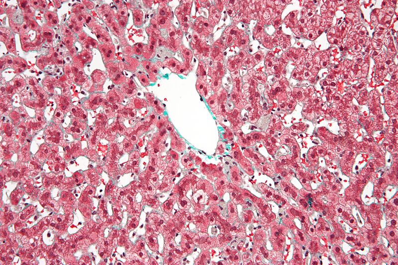 File:Congestive hepatopathy high mag.jpg