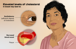 Depiction of a person suffering from high cholesterol