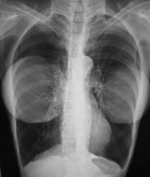 File:BreastImplant09.JPG