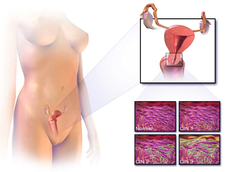 File:Blausen 0221 CervicalDysplasia.png